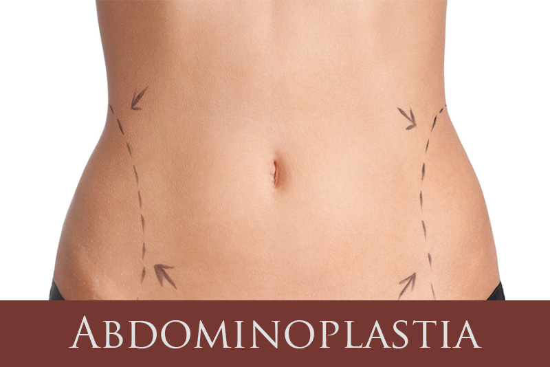 Abdominoplastia